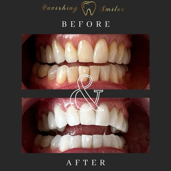 16% Hydrogen Peroxide Teeth Whitening Kit. (Unisex) - Picture 4 of 4